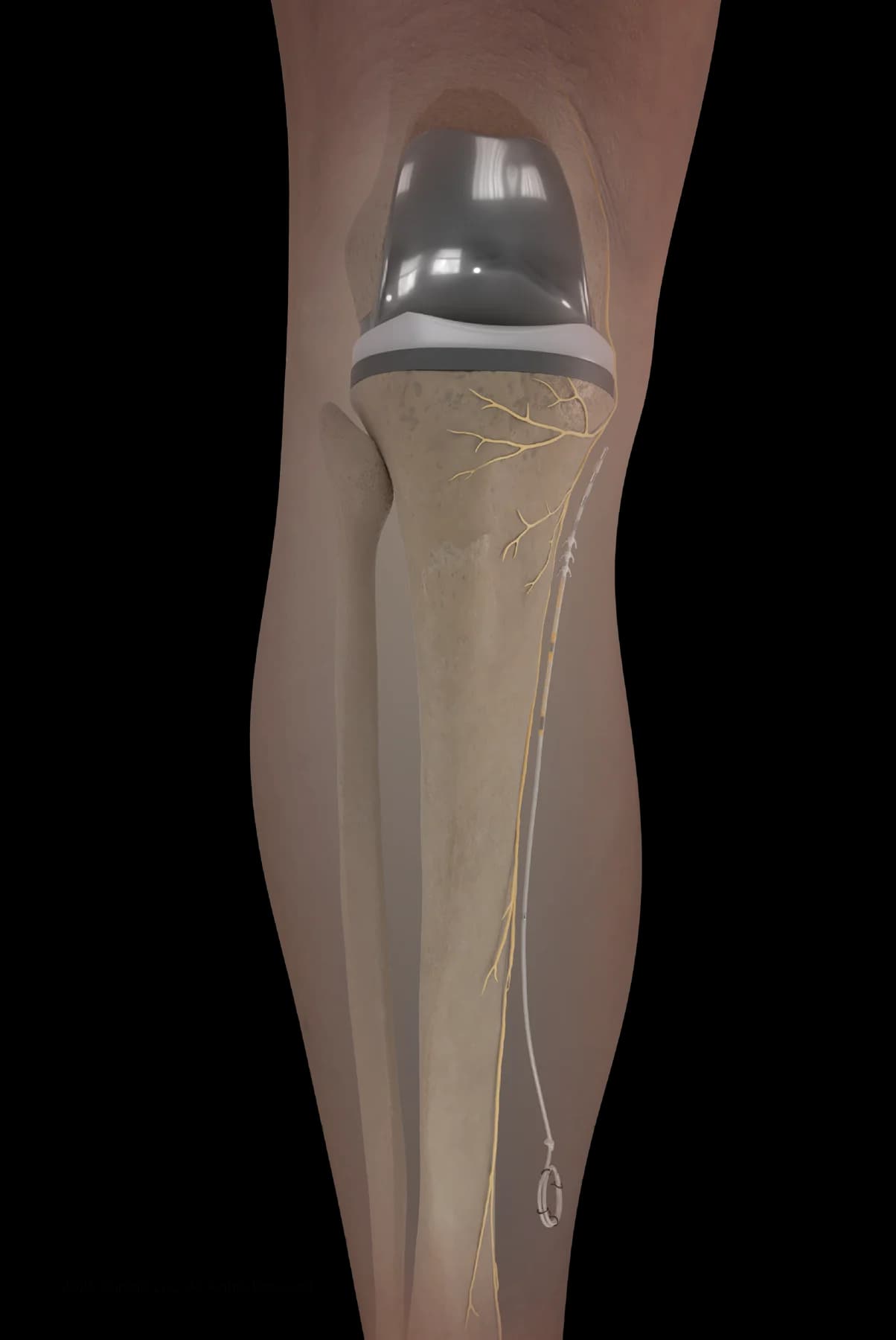 Infrapatellar Saphenous Nerve for Chronic Knee Pain 01