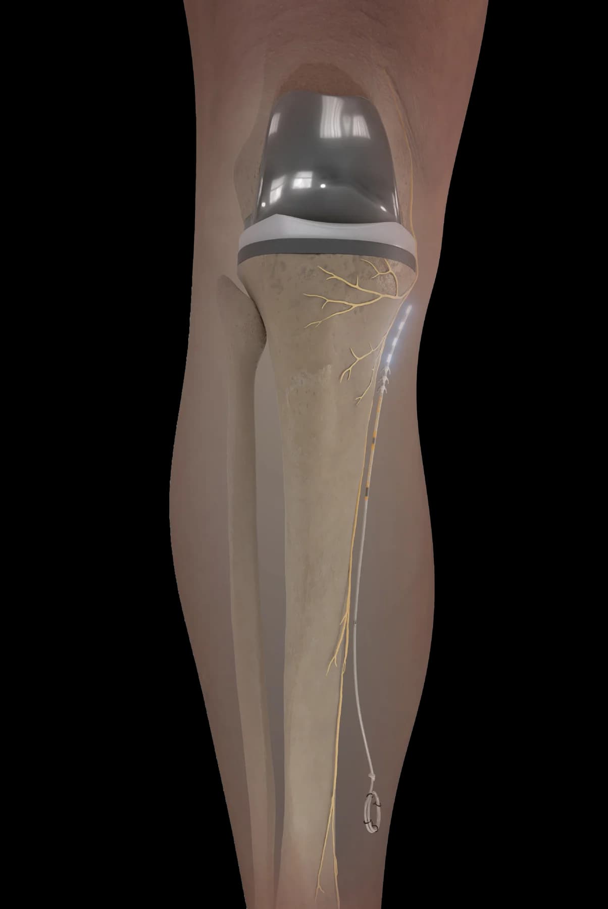 Curonix illustration of the infrapatellar saphenous nerve target for knee pain