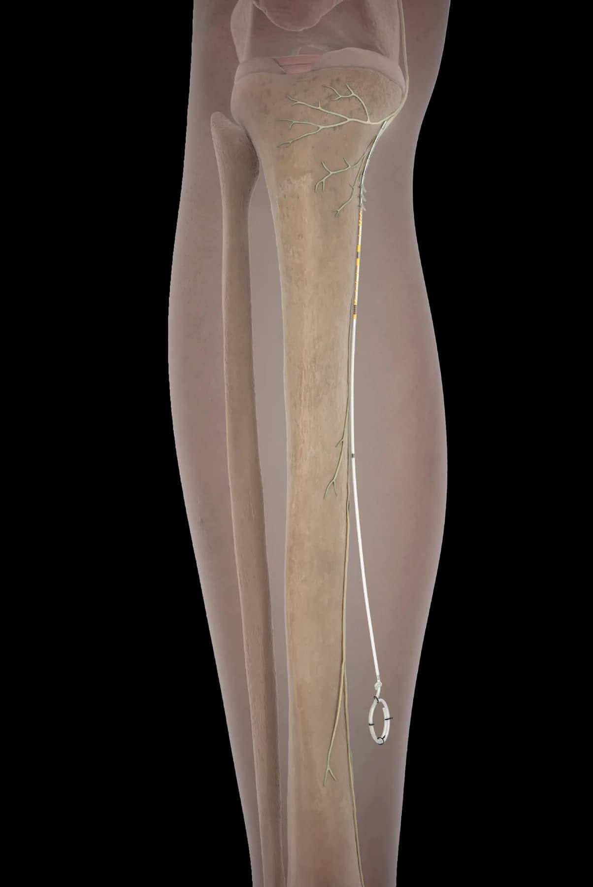 Infrapatellar Saphenous Nerve for Chronic Knee Pain 03