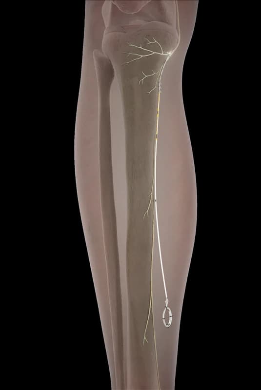 Infrapatellar Saphenous Nerve for Chronic Knee Pain 04