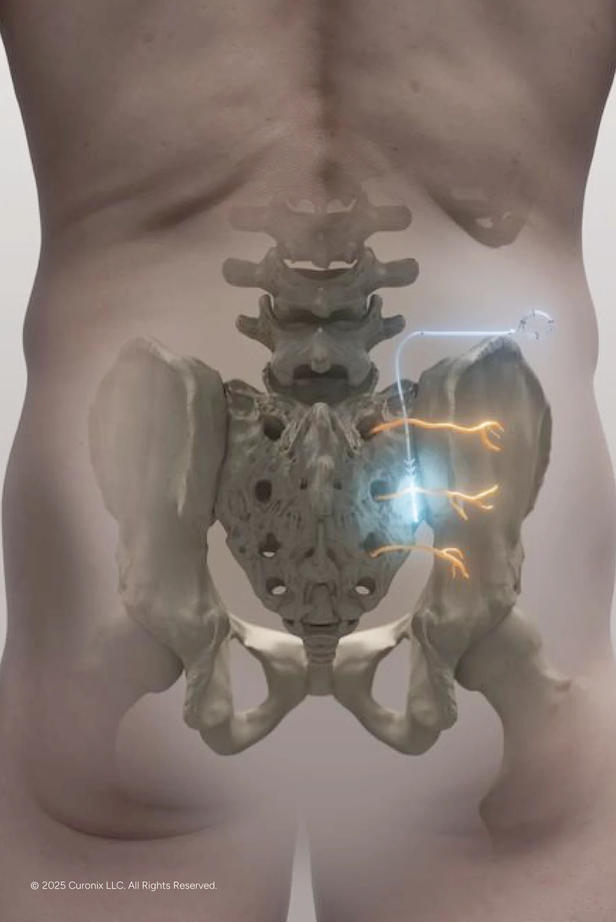 Middle Cluneal Nerve for Chronic Low Back Pain 01