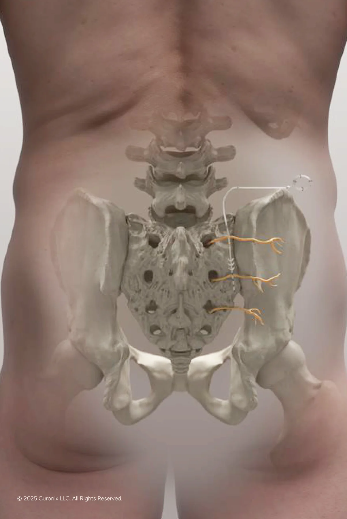 Middle Cluneal Nerve for Chronic Low Back Pain 02