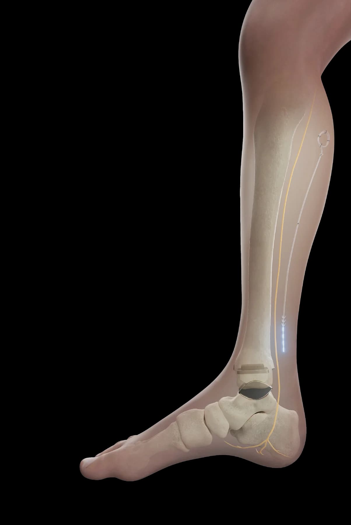 Posterior Tibial Nerve for Chronic Foot & Ankle Pain 01