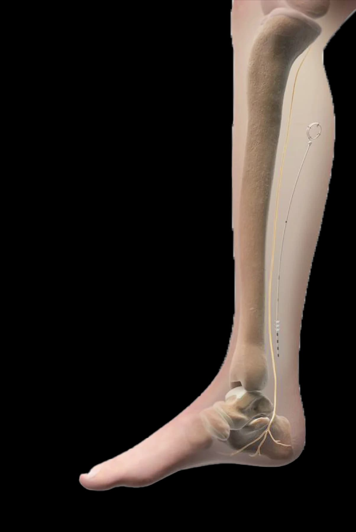Posterior Tibial Nerve for Chronic Foot & Ankle Pain 02