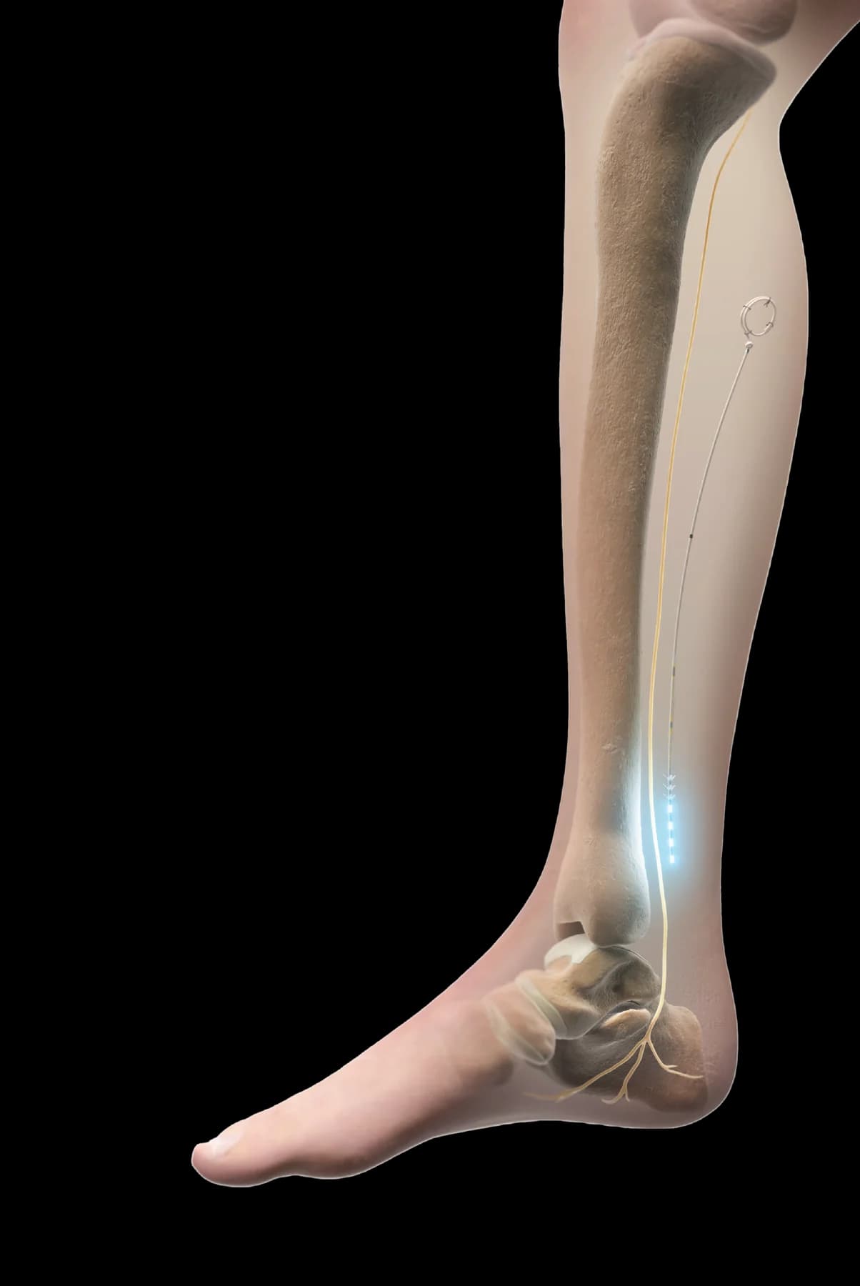 Curonix illustration of the posterior tibial nerve target for foot & ankle pain