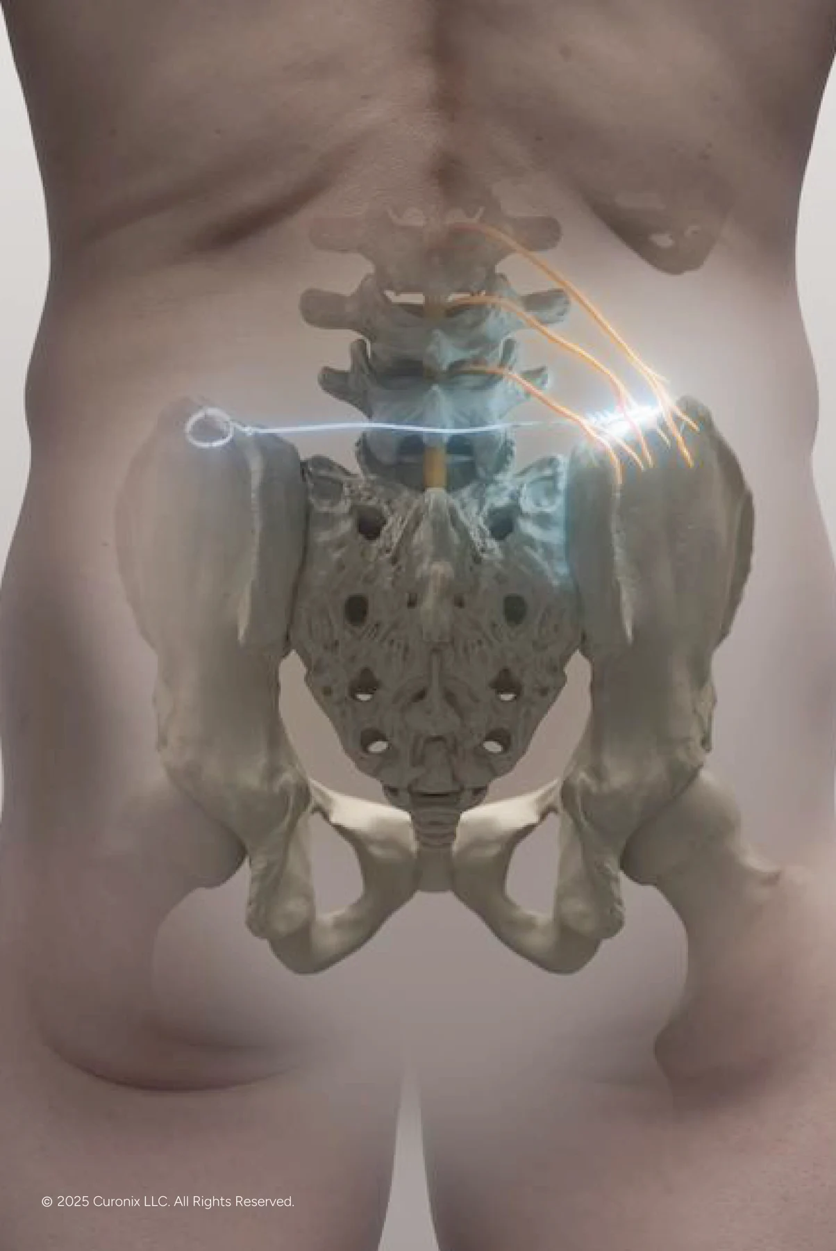 Curonix illustration of the superior and middle cluneal nerves target for low back & si region pain