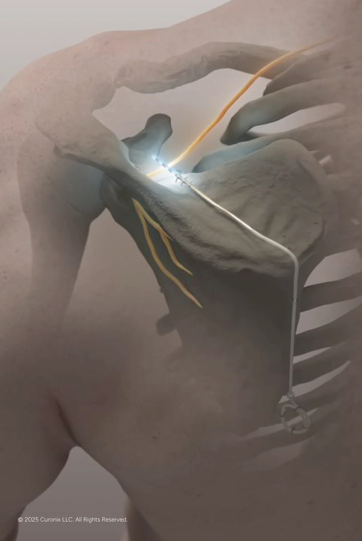 Curonix illustration of the suprascapular nerve target for shoulder pain