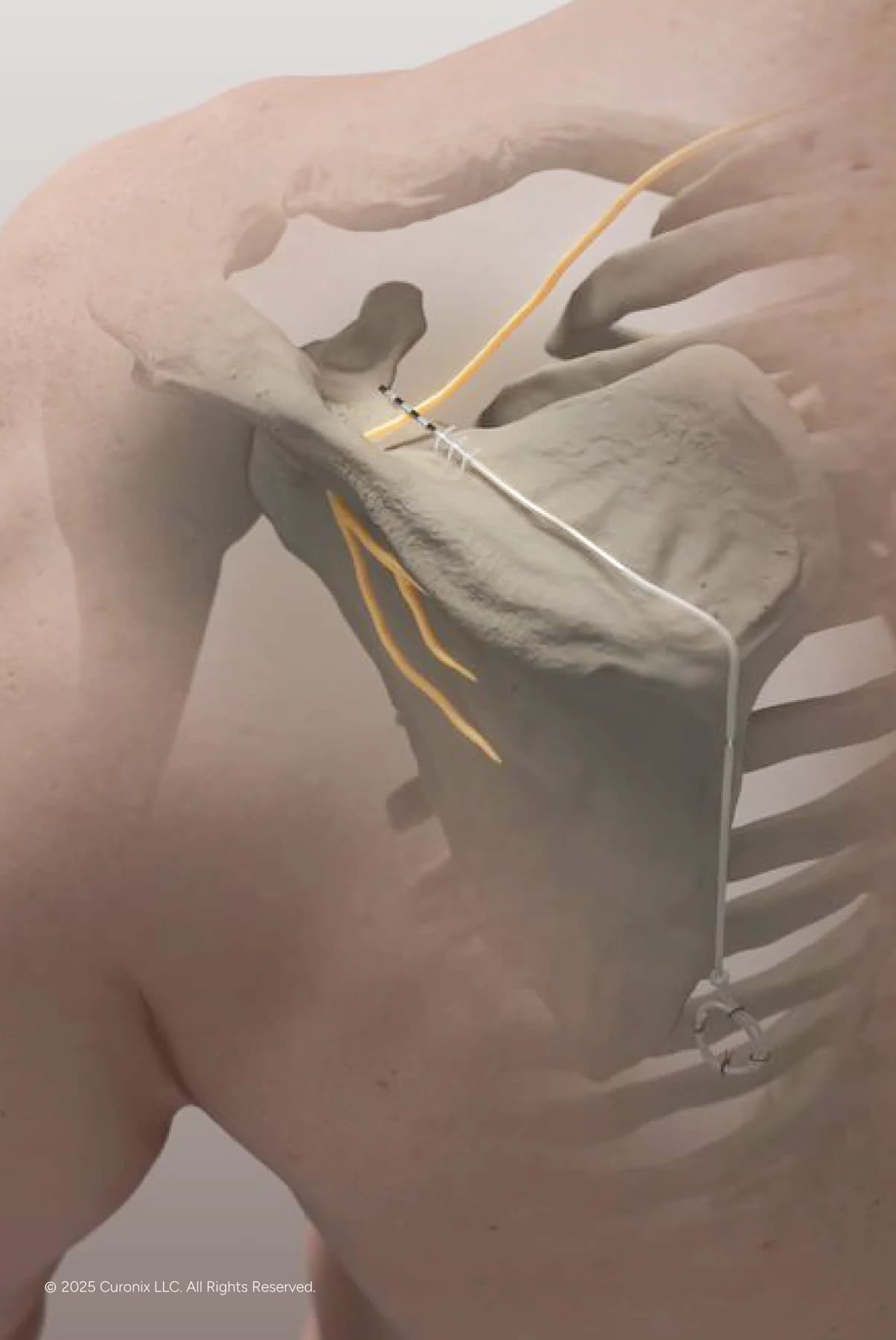Suprascapular Nerve for Chronic Shoulder Pain 02